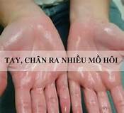 Đông y trị ra mồ hôi tay, chân