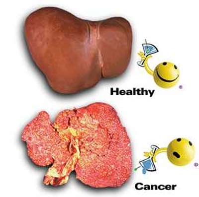 Dấu hiệu nhận biết viêm gan B