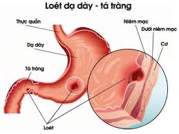 Bài thuốc chữa viêm loét dạ dày - tá tràng